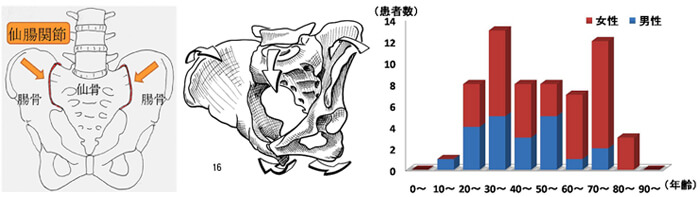 仙腸関節障害の性別・年齢分布