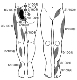 仙腸関節障害の疼痛部位